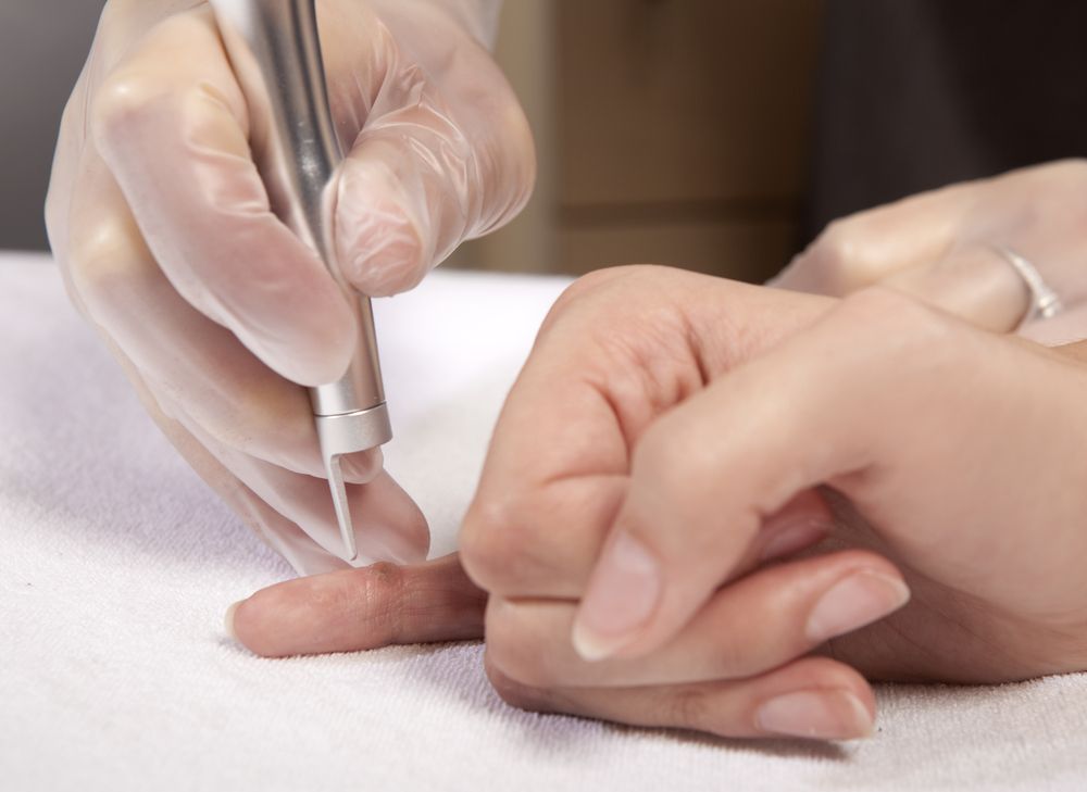 Wart removal in Southfield Michigan